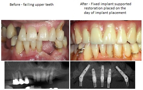 Before And After Implant Denture pics from Alexander Pritsky, DMD in Fresno, CA